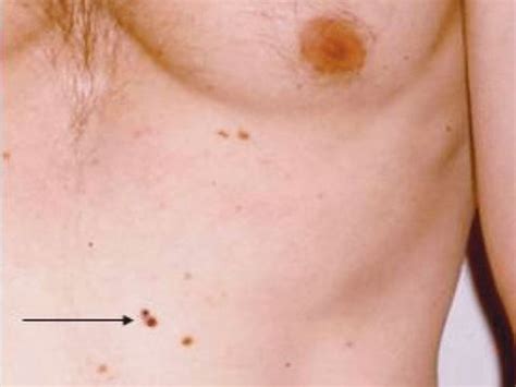 Breast cancer symptoms: What chest freckles can mean